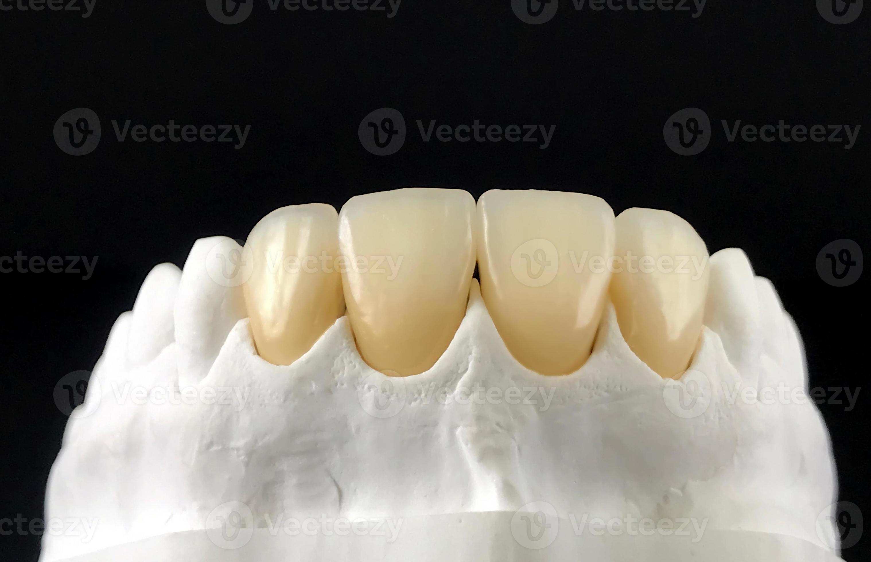 Dental veneers and crowns in the plaster model for treatment and new