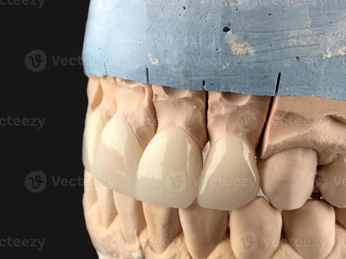 Prensa coronas y carillas de cerámica a 1 color. carillas de dientes frontales blancos en el modelo de diagnóstico sobre fondo oscuro. implante dental. restauración de dientes. laboratorio dental, clínica. foto