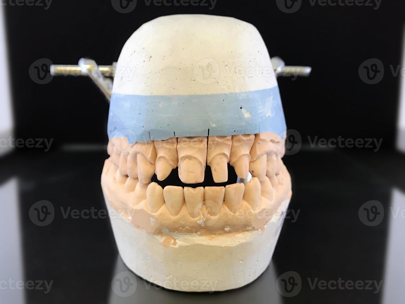 modelo de yeso dental colapsable en el oclusor del maxilar superior e inferior de una persona para la fabricacion de coronas de ceramica. laboratorio dental, clínica. prótesis dentales foto