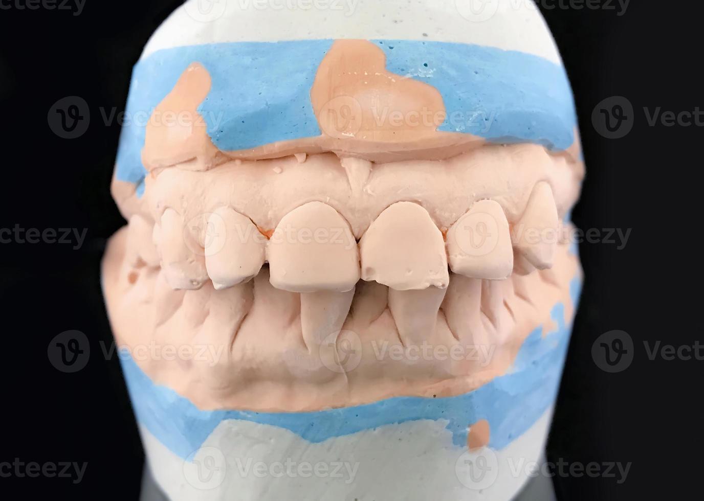 Plaster casting model on black background. Close up dental plaster mould of the dentist. Front