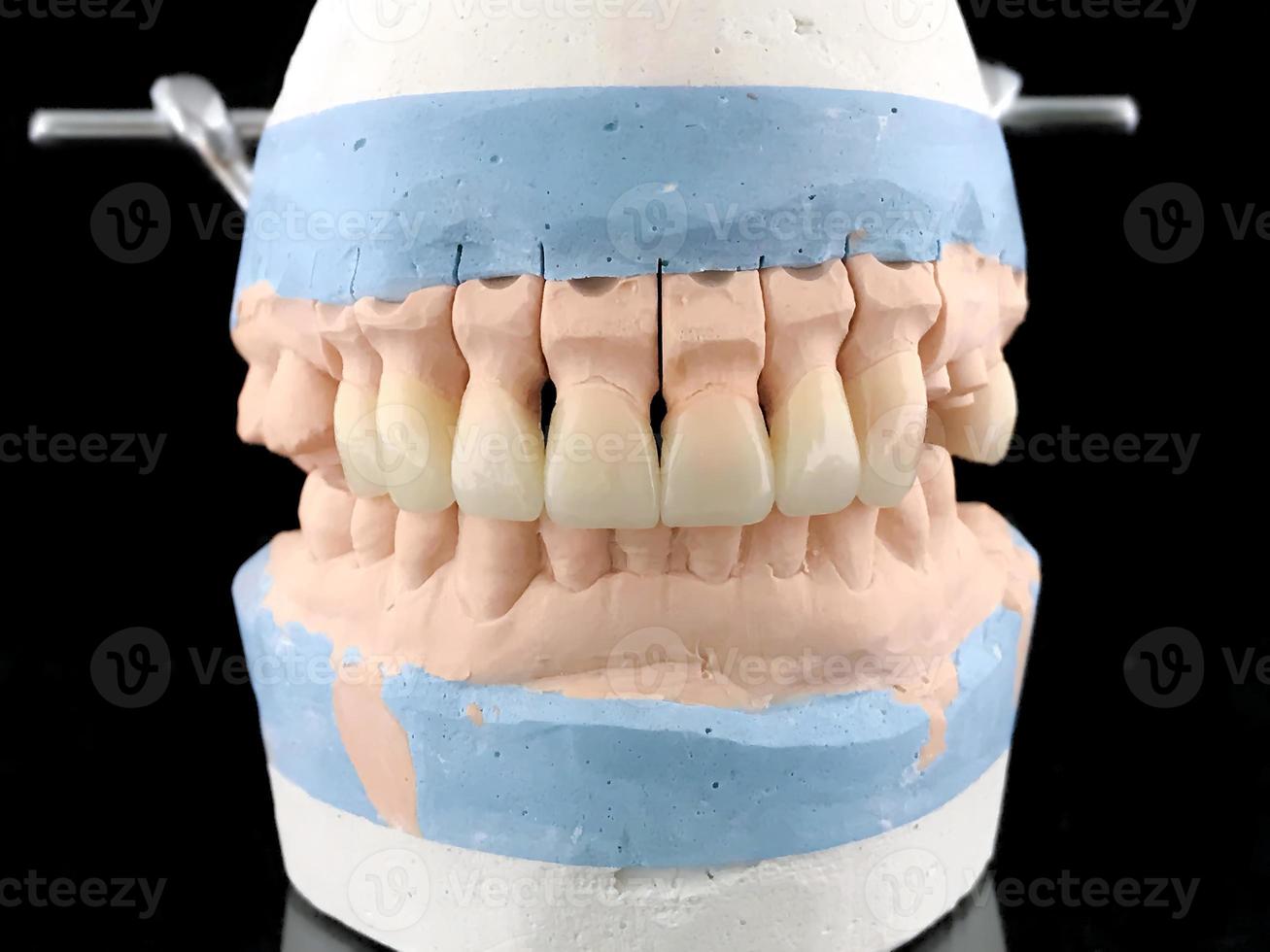 Dental porcelain prosthesis implant tooth in dental laboratory. Plaster model with all-ceramic bridge restoration. Lithium disilicate. Front view. Lower and upper jaw. Dental gypsum model photo