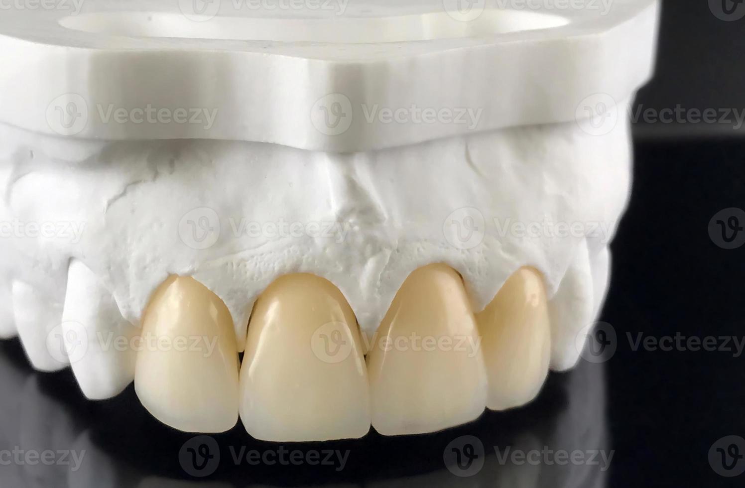 Zirconia crowns with all porcelain baked. Close-up view of dental layout of upper veneers of teeth prosthesis, isolated on black background. Dental crowns for the upper jaw on model photo