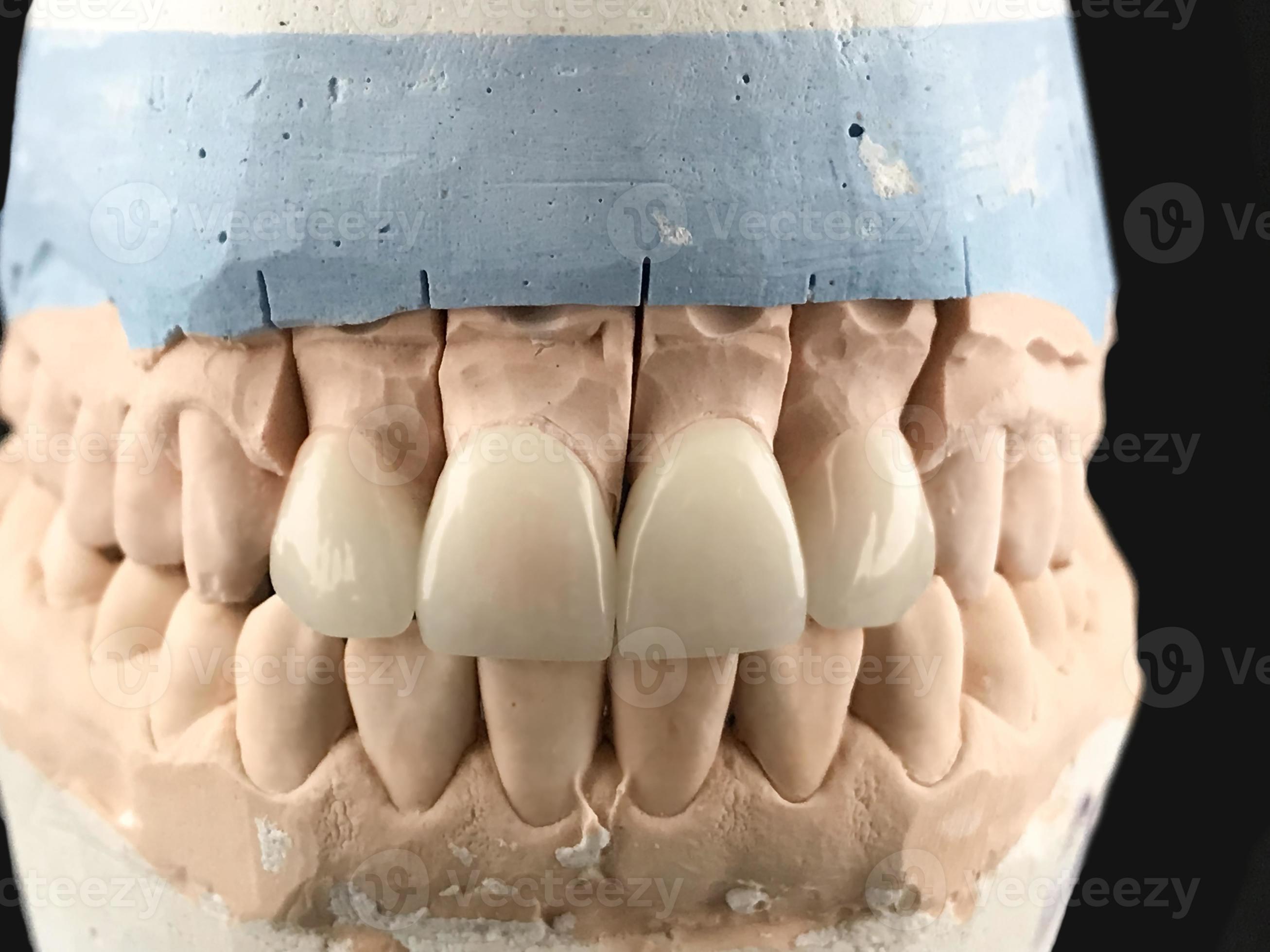 primer plano de prótesis dentales dientes de porcelana en un molde. modelo  de yeso de mandíbula dental y equipo dental sobre fondo negro, concepto de  imagen médica de salud dental, higiene dental