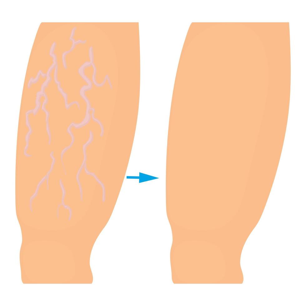 Varicose veins operation icon, cartoon style vector