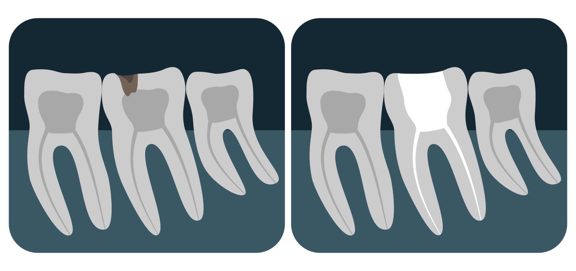 radiografía de dientes humanos. tres molares sanos en una radiografía. ilustración vectorial vector