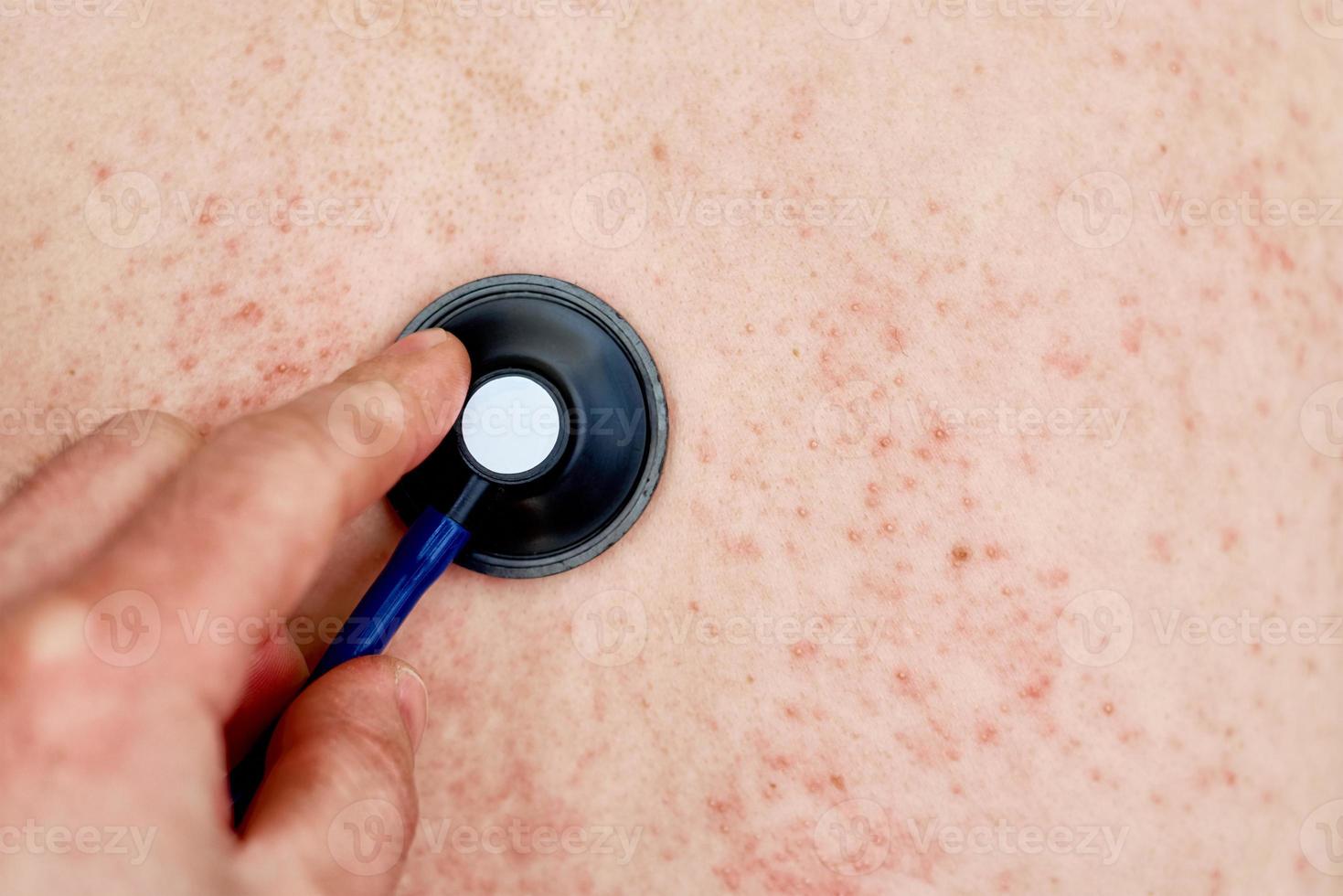 Allergic rash on skin. Woman with dermatology problem on back skin photo