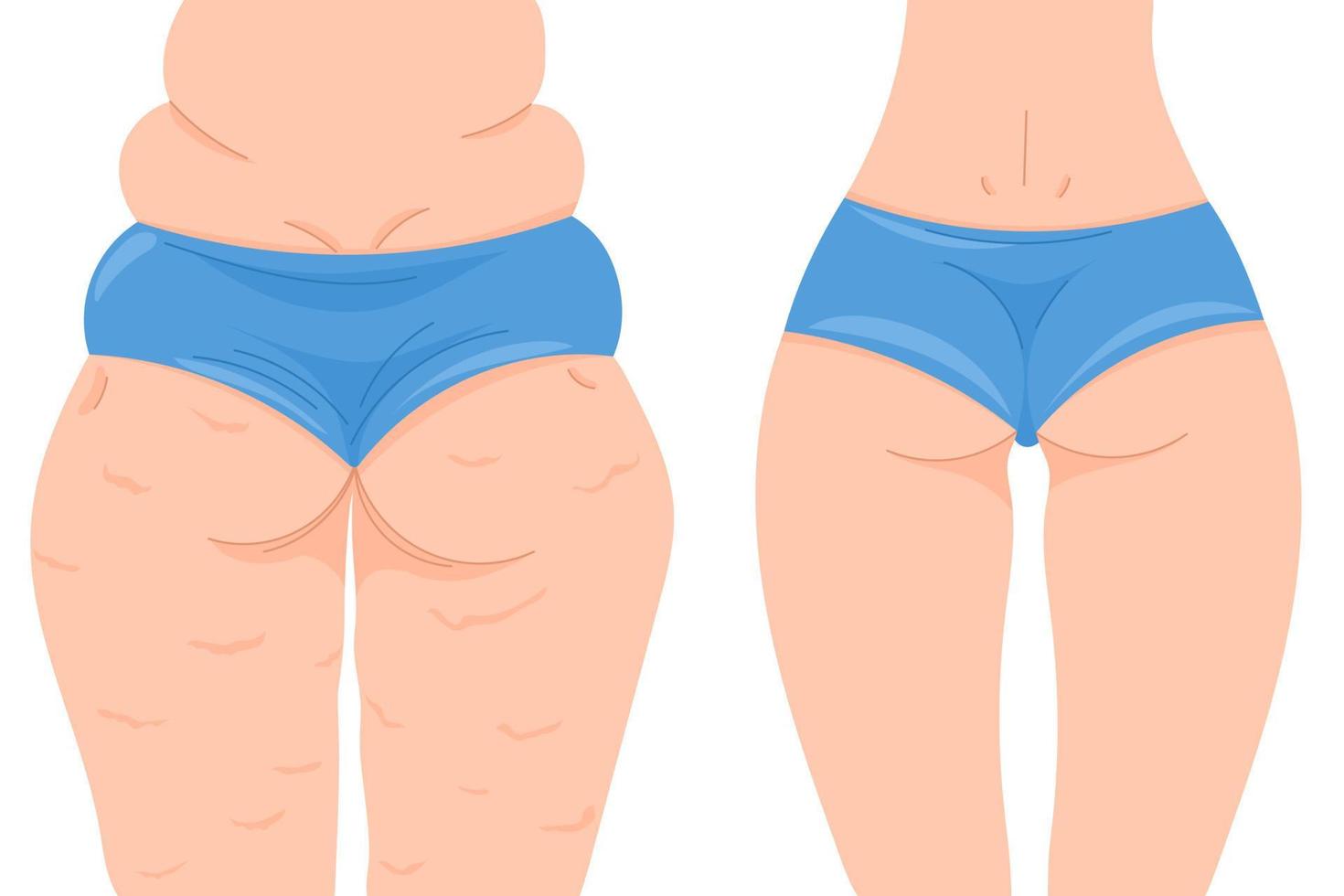 Color vector illustration before and after losing weight. Female back view with and without cellulite. Female buttocks in a blue panties