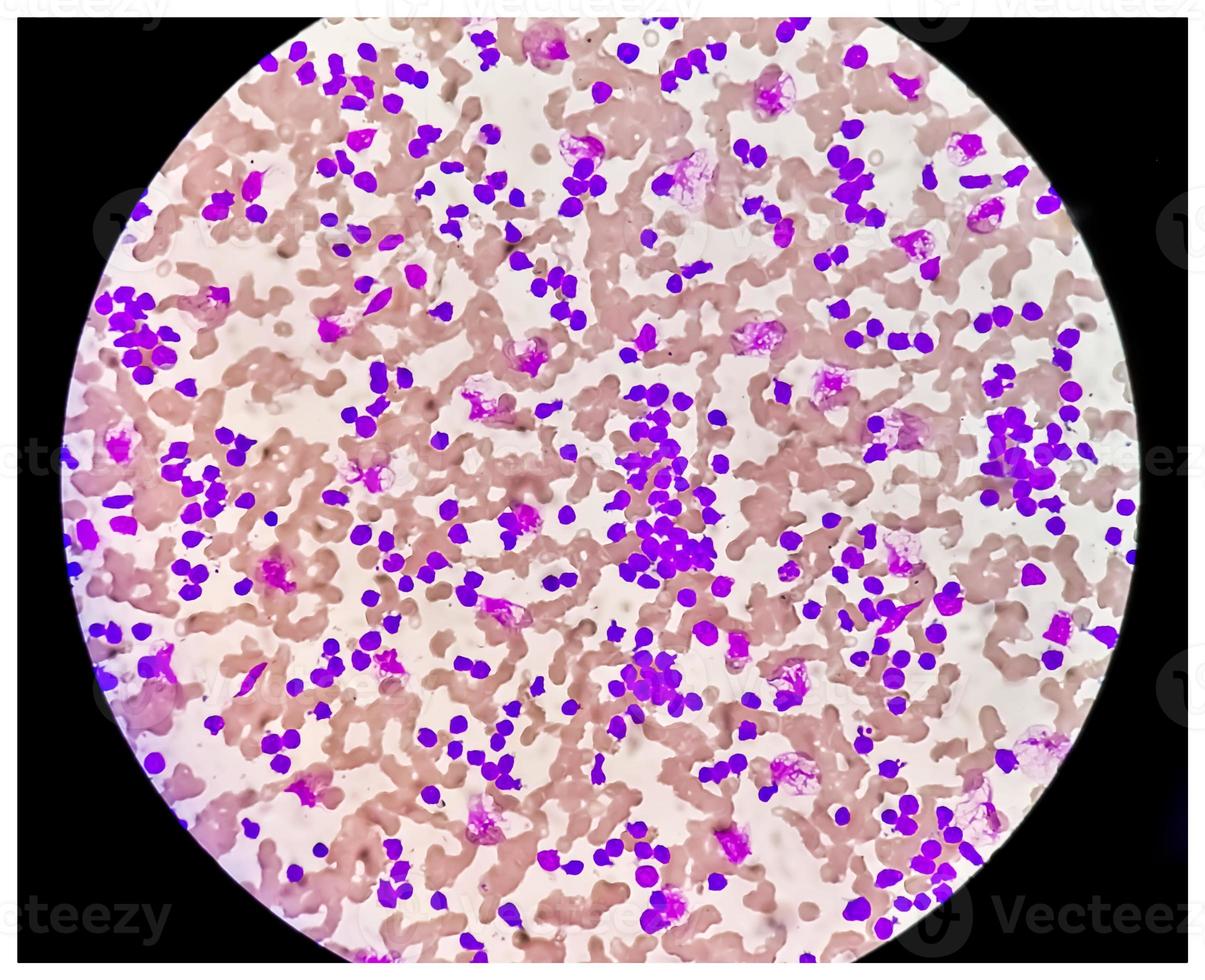 Blood smear under microscopy showing chronic lymphoblastic leukemia or CLL photo