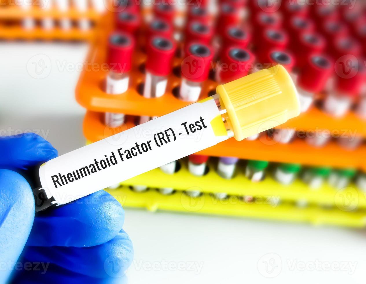 Blood sample RF or Rheumatoid factor or RA or Rheumatoid arthritis test, diagnosis for rheumatoid arthritis disease. photo