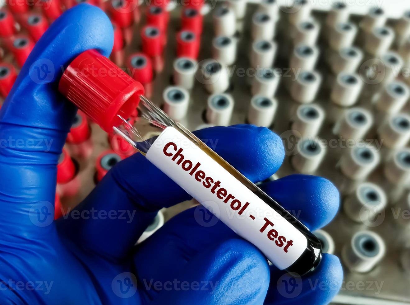 Blood sample for Cholesterol Test, Lipid profile. Myocardial Infraction. photo