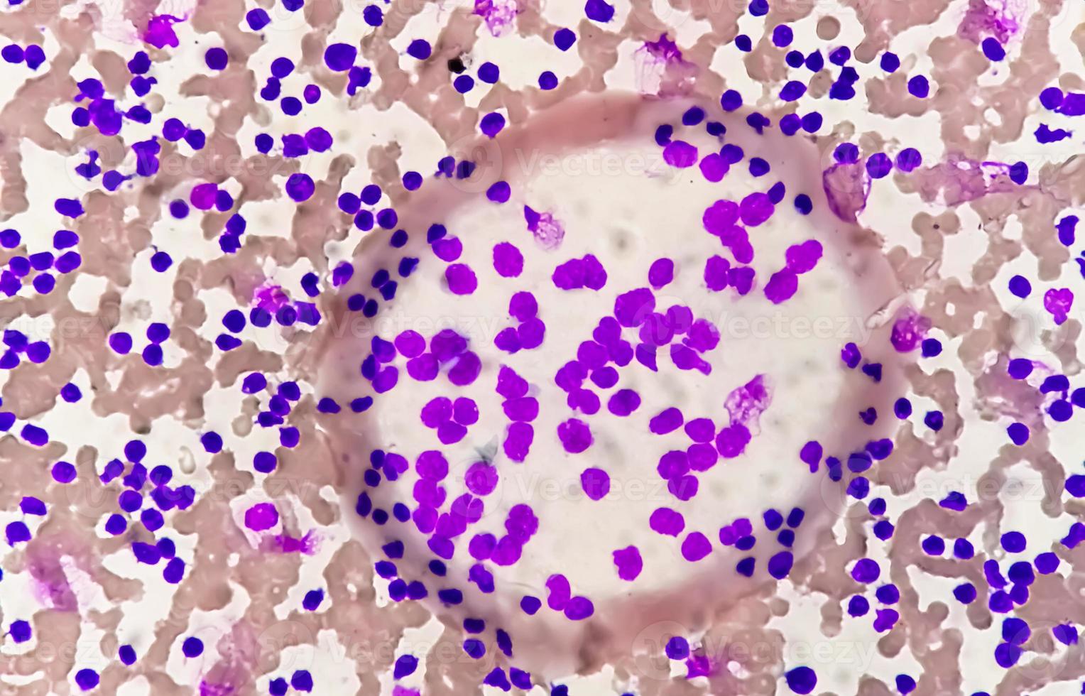 Blood smear under microscopy showing chronic lymphoblastic leukemia or CLL photo