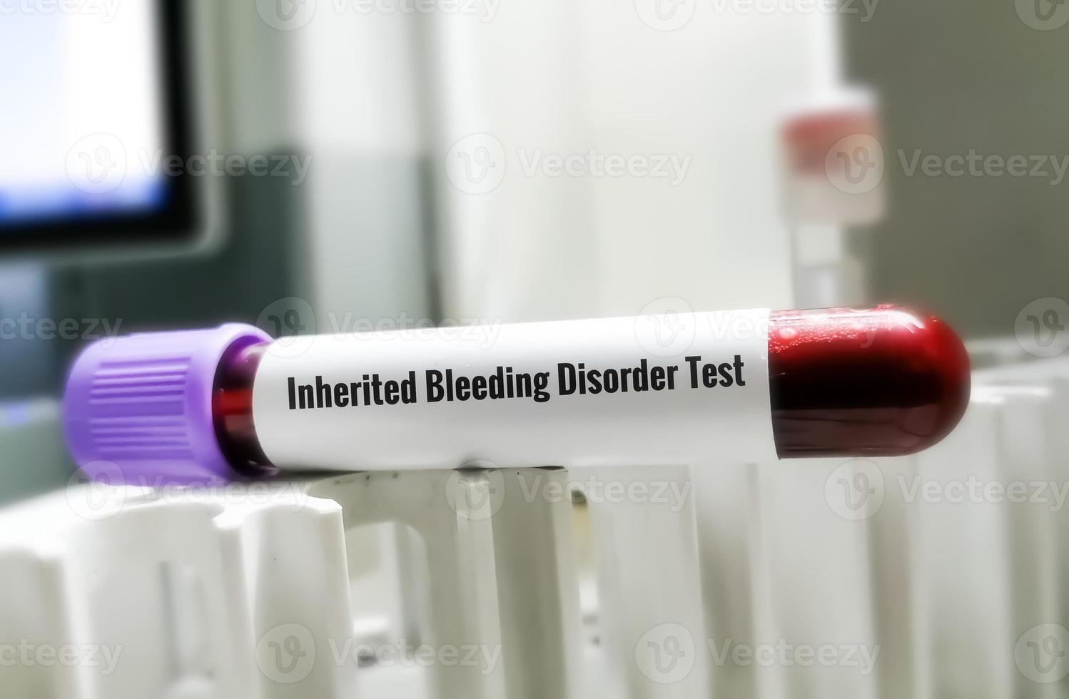 Blood sample for inherited bleeding disorder test, hemophilia. photo