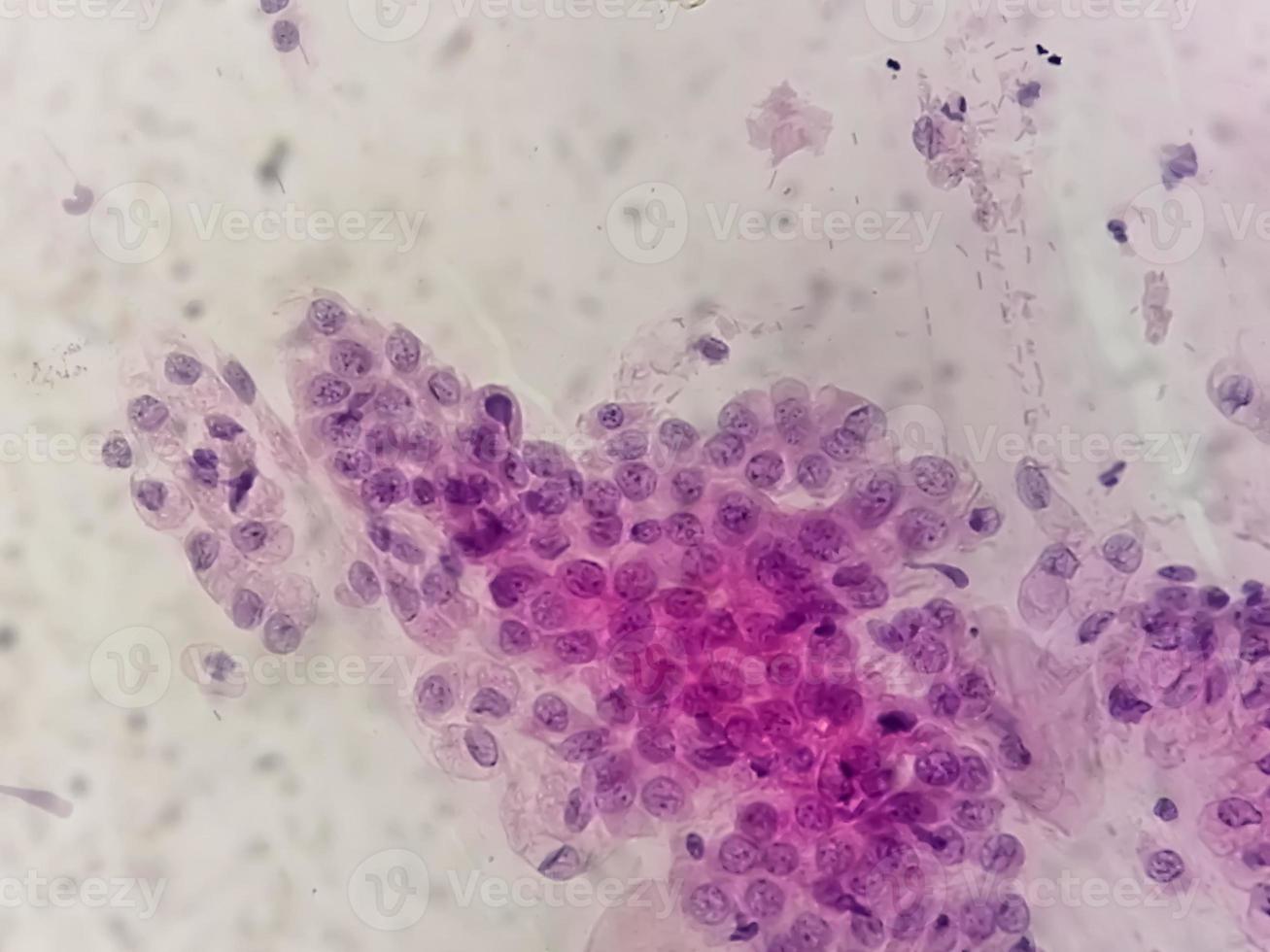 Microscopic view of Trichomonas vaginalis in pap smear with few acute inflammatory cells. photo