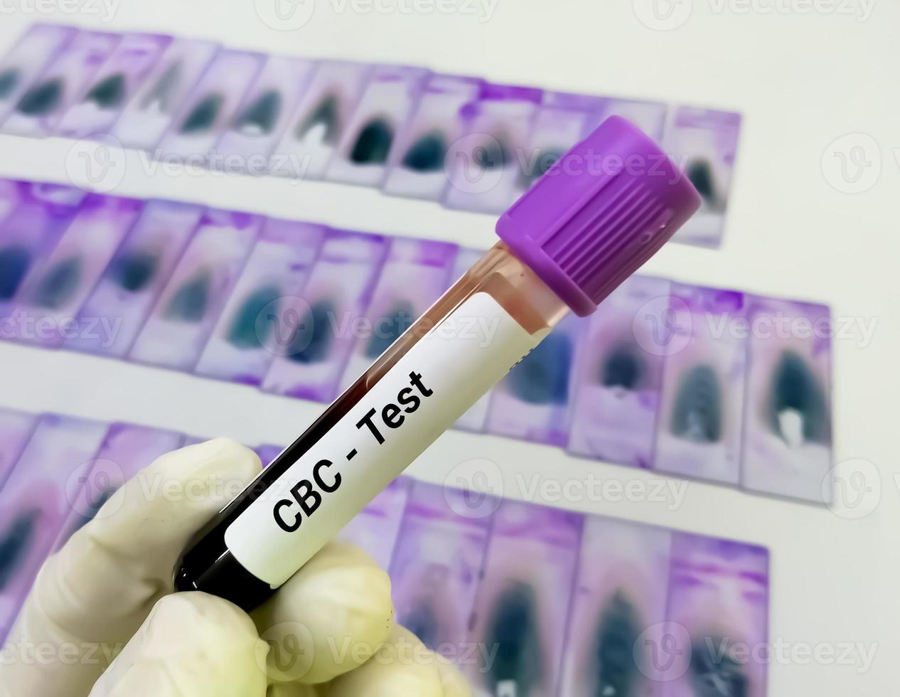 Blood sample for CBC or Complete blood count test. Hematological analysis. photo