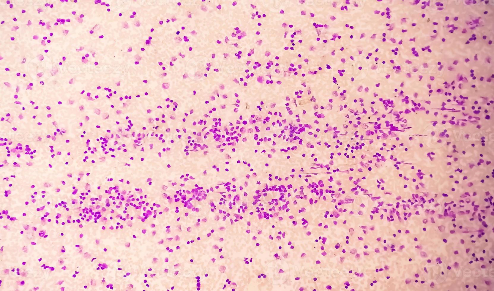 Blood smear under microscopy showing chronic lymphoblastic leukemia or CLL photo