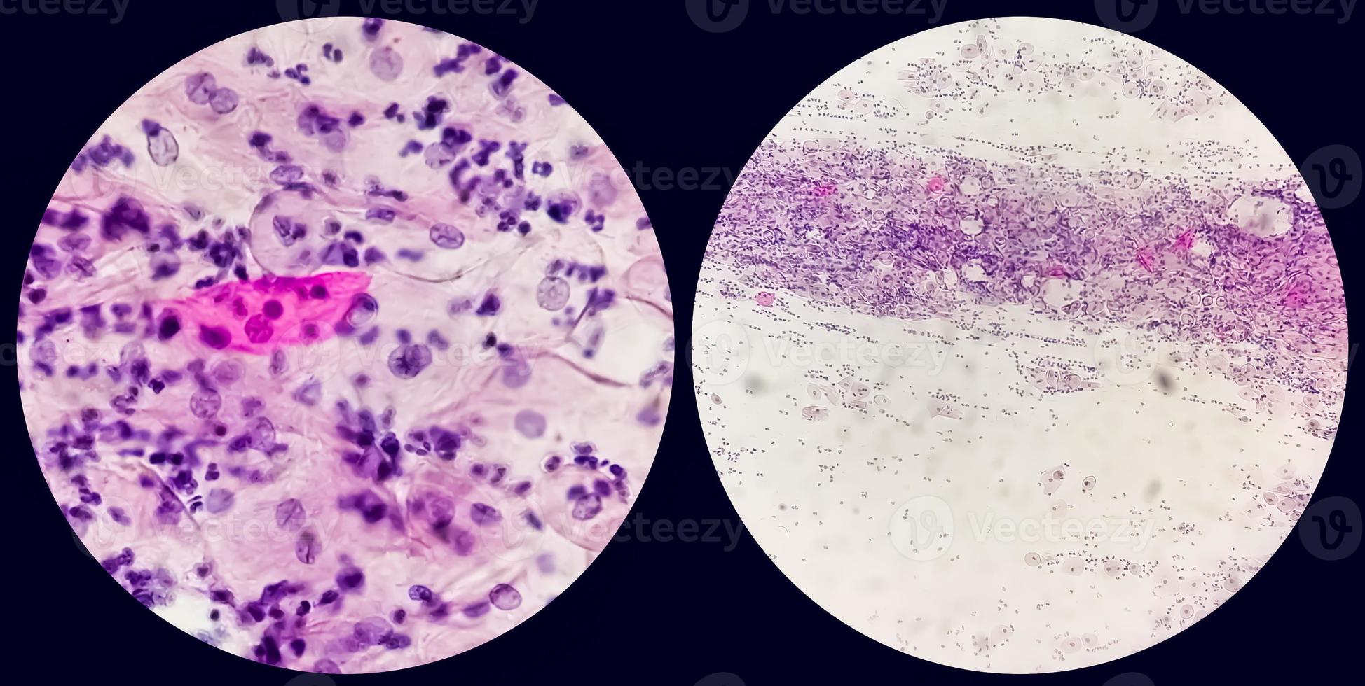 Paps smear. Microscopic examination of pap smear showing inflammatory smear with early atrophic changes. cervical cancer diagnosis. photo