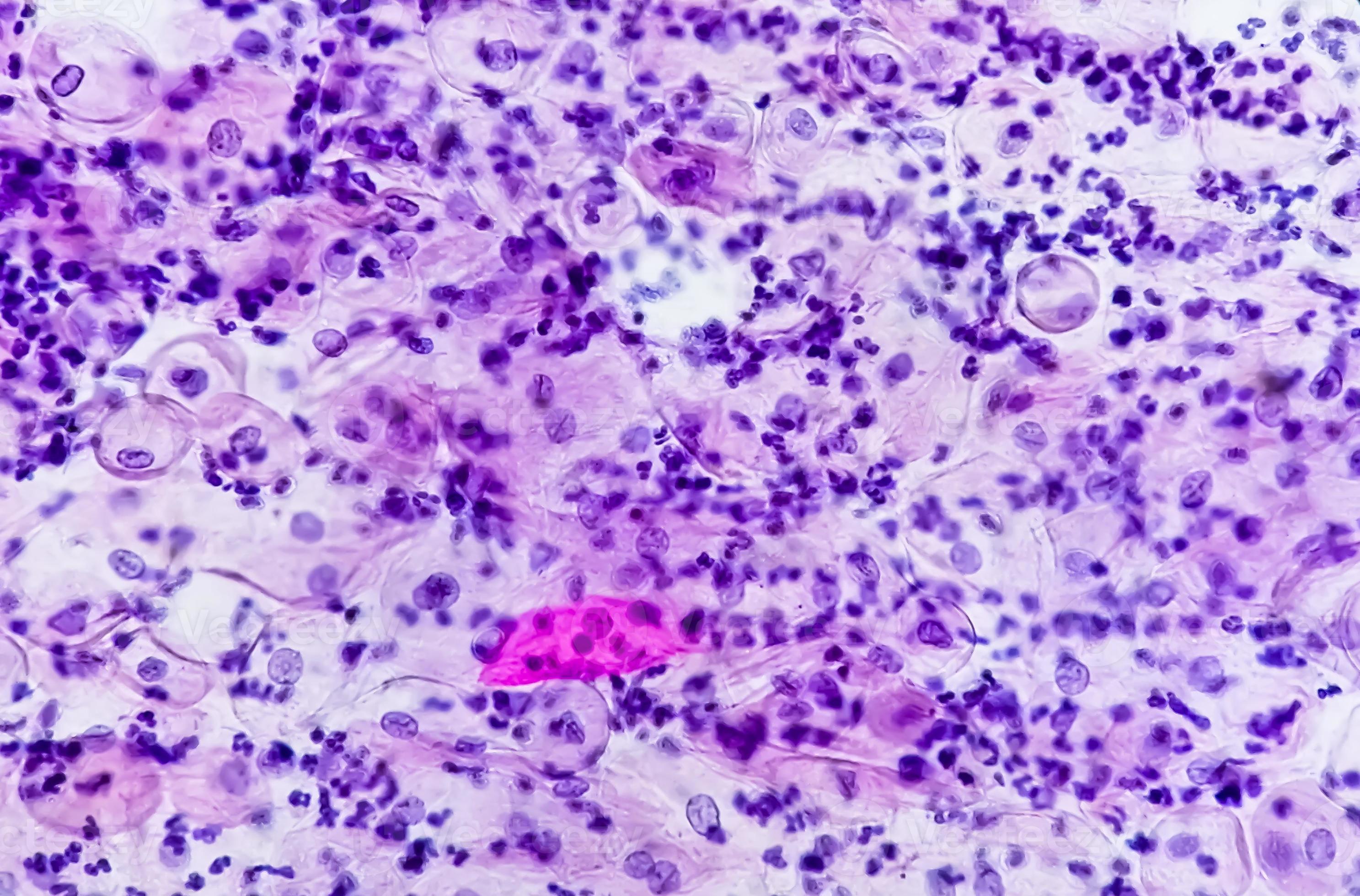 paps-smear-microscopic-examination-of-pap-smear-showing-inflammatory