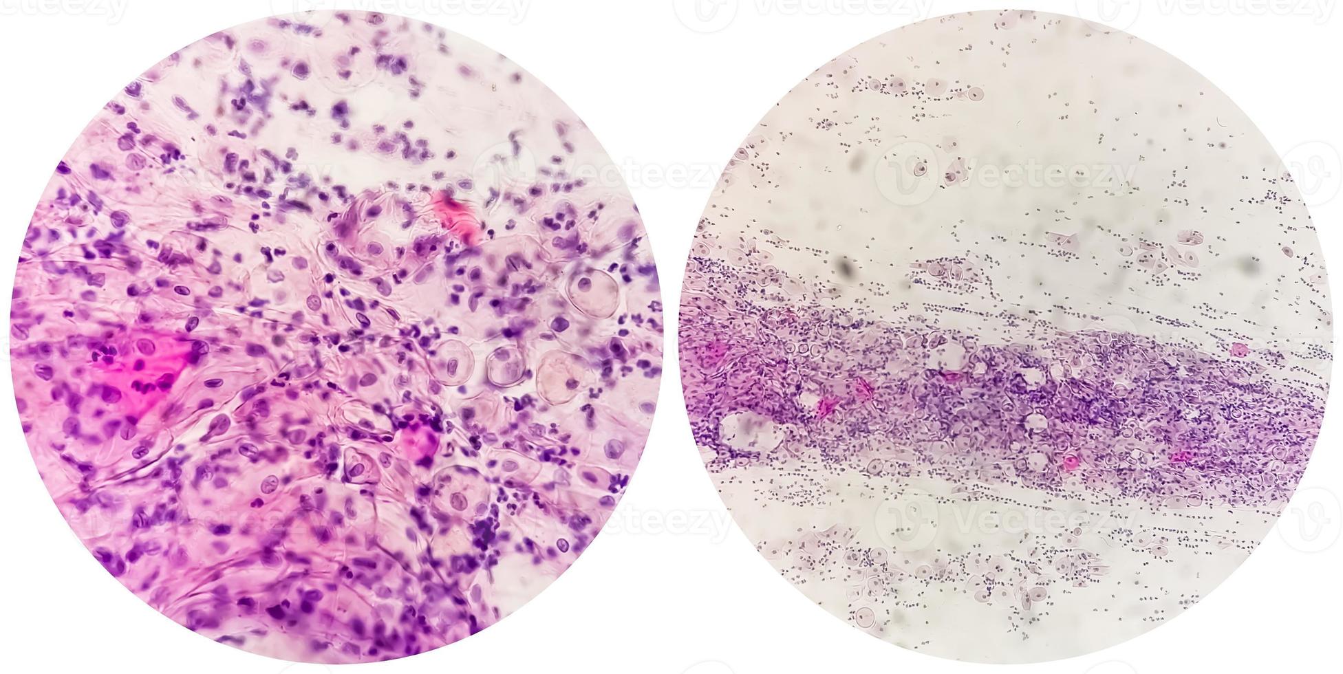 Paps smear. Microscopic examination of pap smear showing inflammatory smear with early atrophic changes. cervical cancer diagnosis. photo
