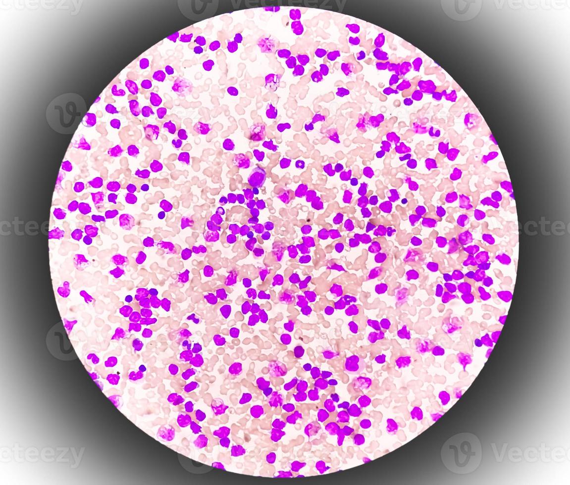 Blood smear under microscopy showing chronic lymphoblastic leukemia or CLL photo