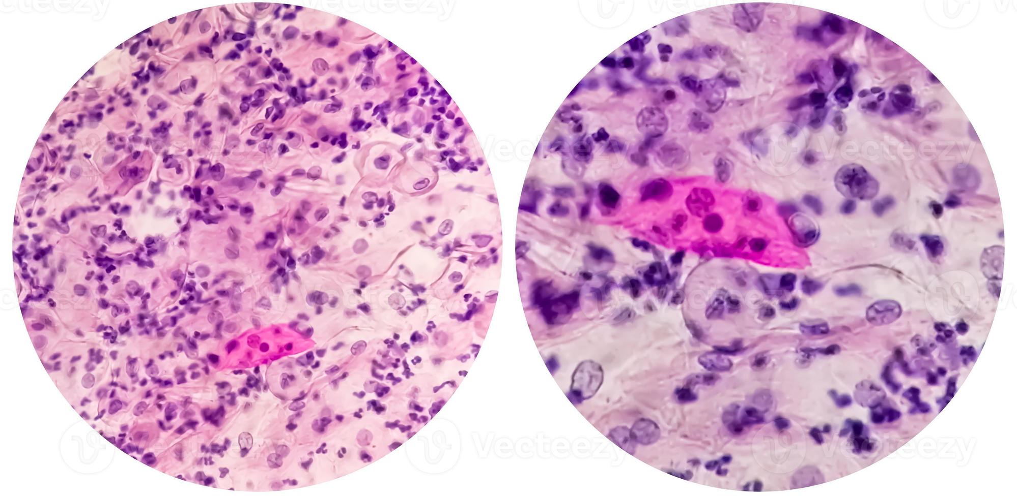 Paps smear. Microscopic examination of pap smear showing inflammatory smear with early atrophic changes. cervical cancer diagnosis. photo