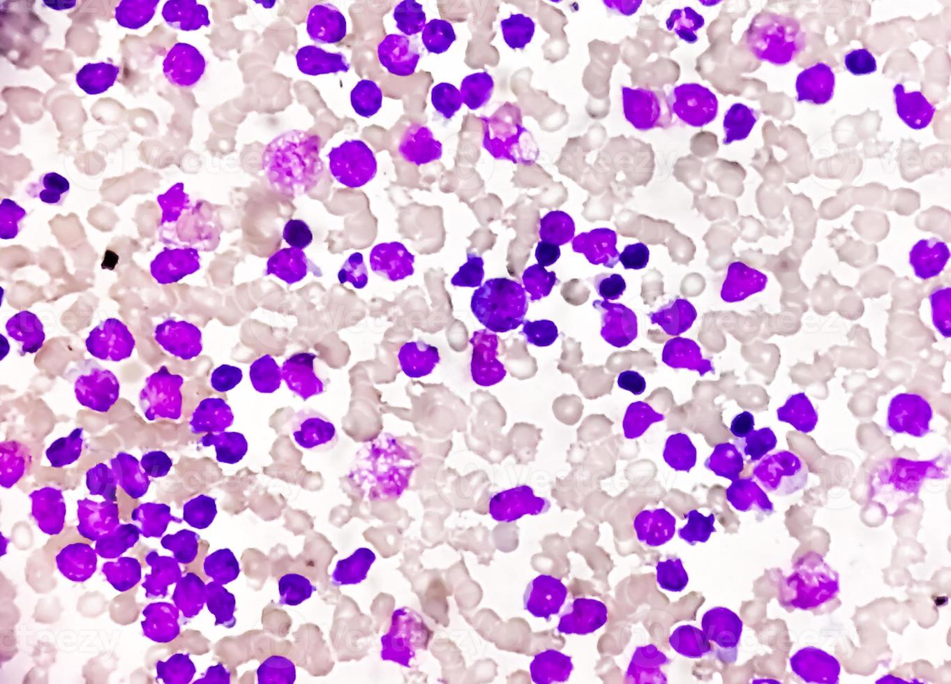Blood smear under microscopy showing chronic lymphoblastic leukemia or CLL photo