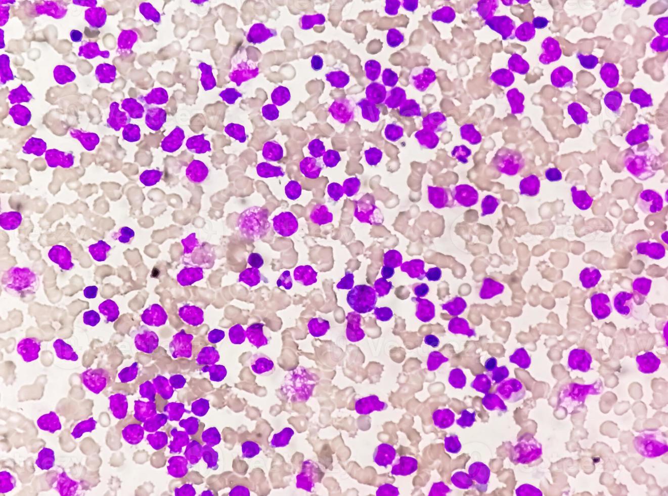 Blood smear under microscopy showing chronic lymphoblastic leukemia or CLL photo