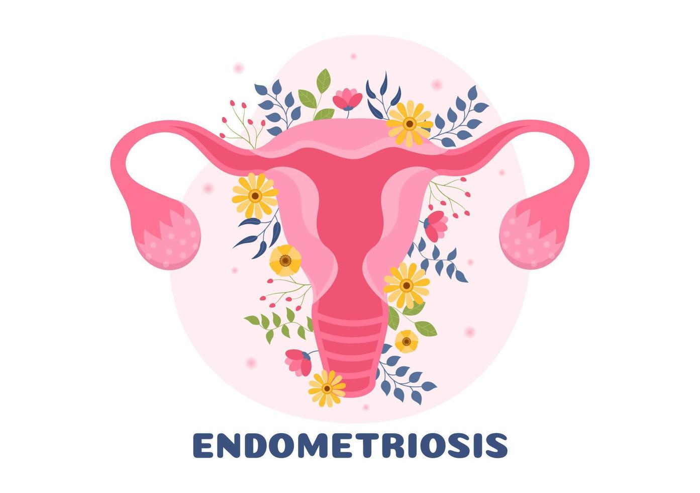 Endometriosis with Condition the Endometrium Grows Outside the Uterine Wall in Women for Treatment in Flat Cartoon Hand Drawn Templates Illustration vector
