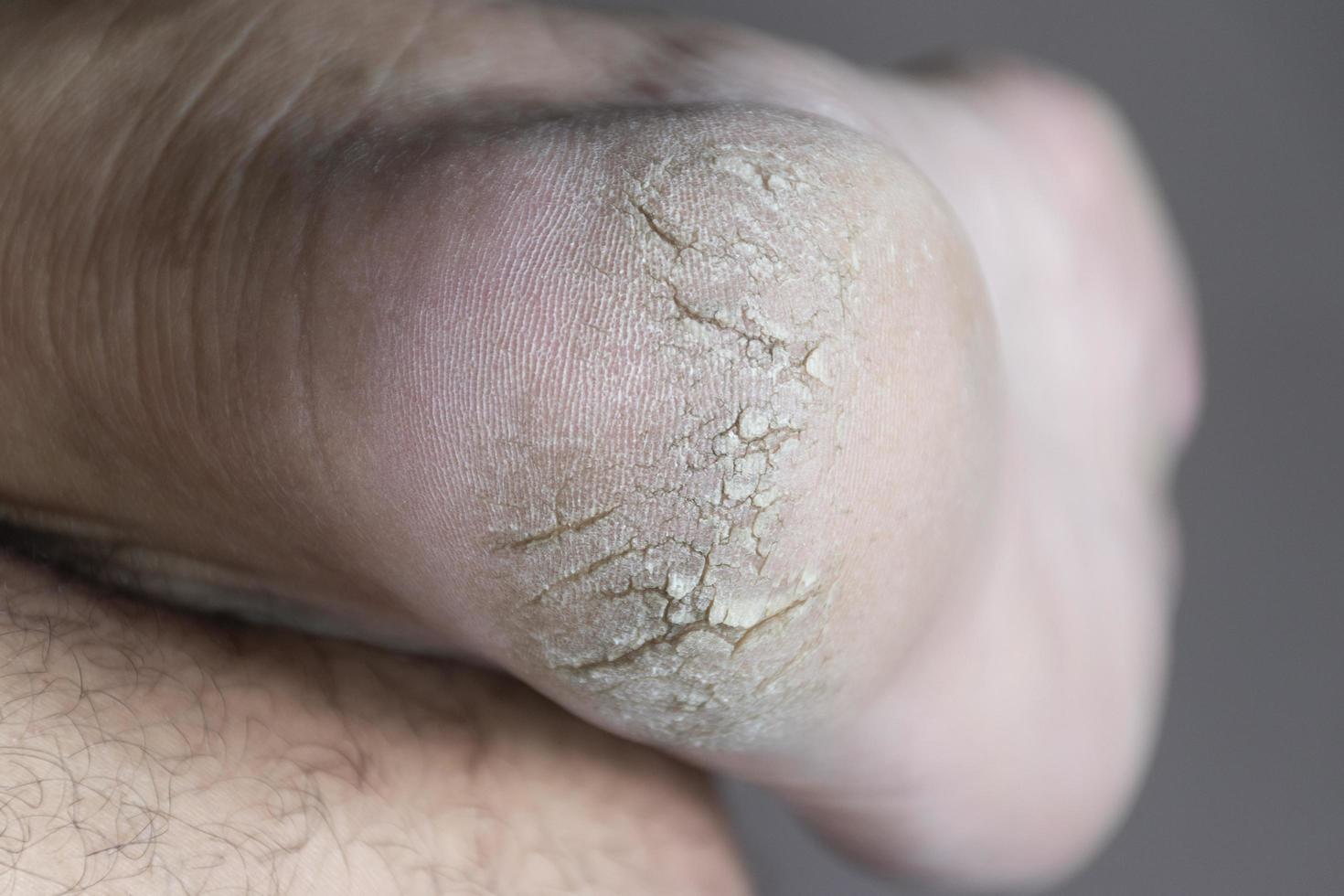 Close up cracked heel further deep cracks and dry flaky skin photo