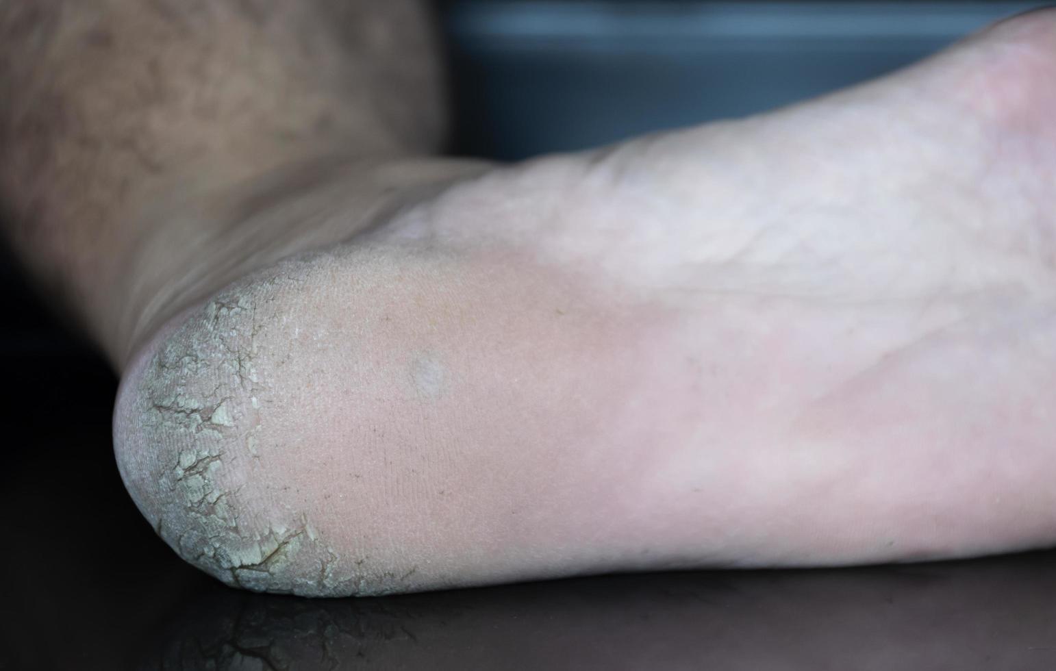 Close up cracked heel further deep cracks and dry flaky skin photo