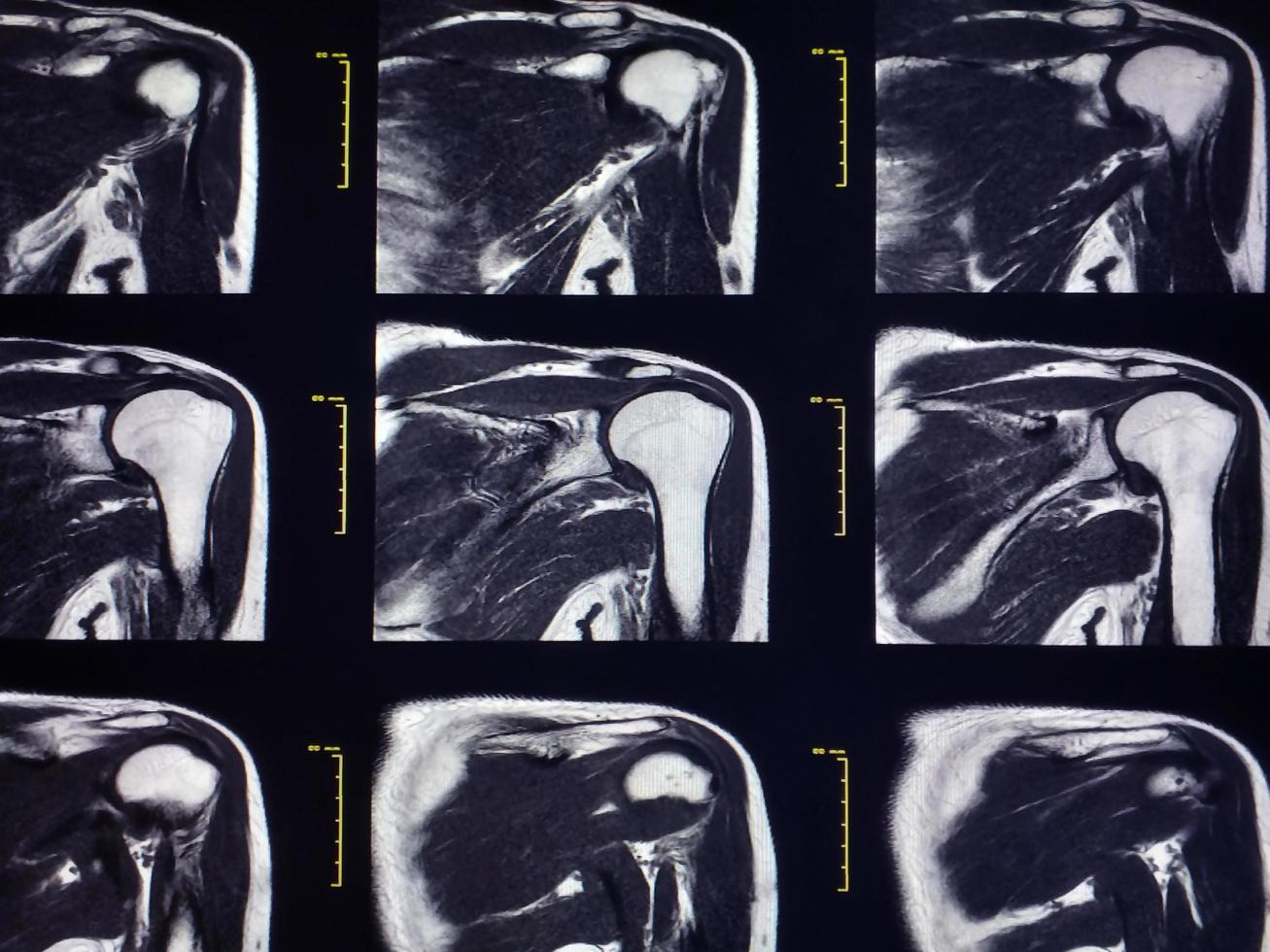 Magnetic resonance imaging of Shoulder Joint photo