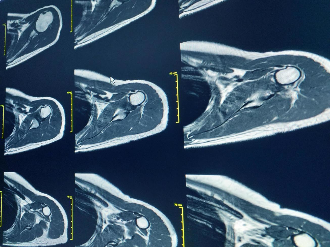 Magnetic resonance imaging of Shoulder Joint photo