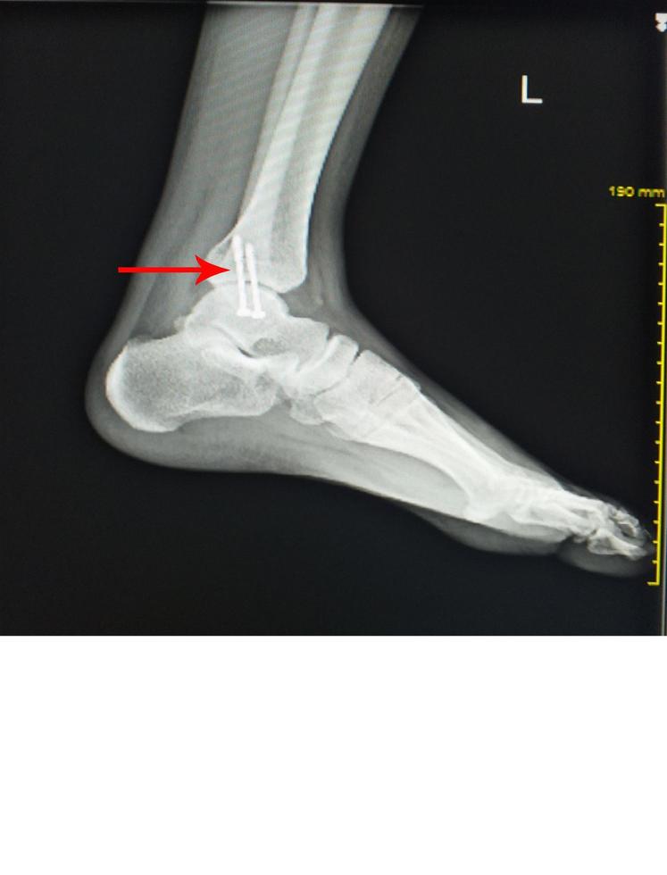 X-ray foot after operation fix screws in medial malleolus tibia. photo