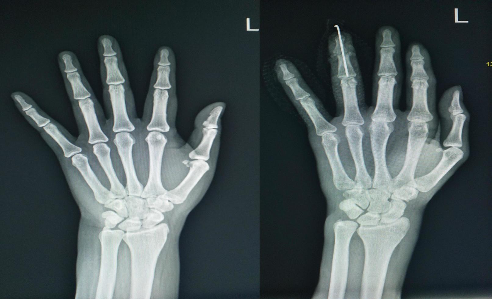 radiografía de la mano izquierda dos vistas encontrando dedo normal y fractura. foto