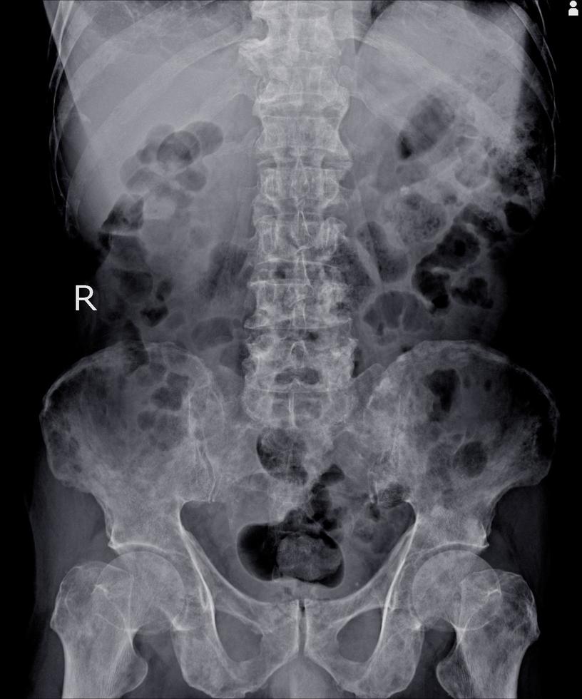 X-ray Lumbar spine impression Multiple bone metastasis. photo