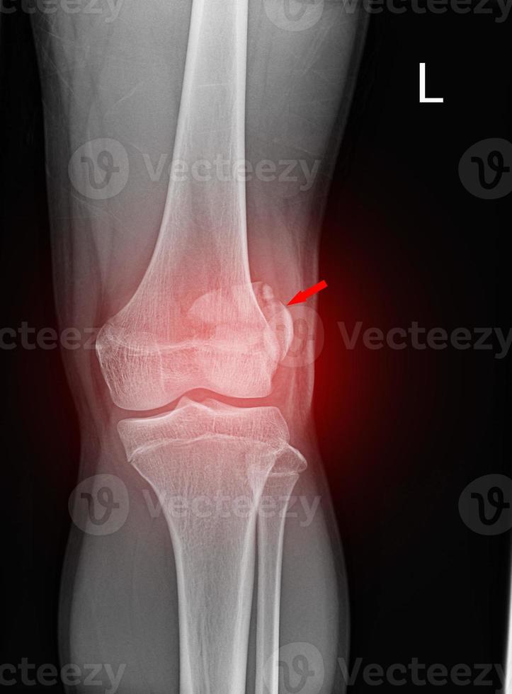 A film x-ray of left knee lateral view shown fracture of knee cap patella bone photo