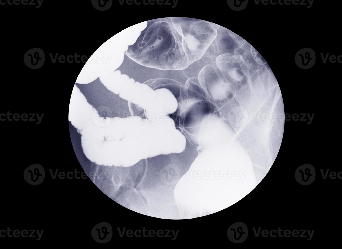 Barium enema examination lower gastrointestinal photo