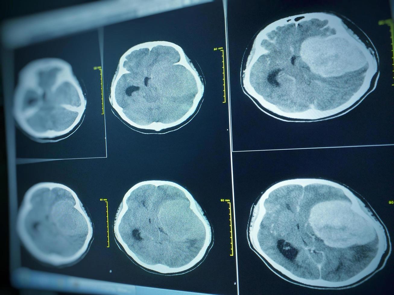 MRI BRAIN Finding of meningioma photo