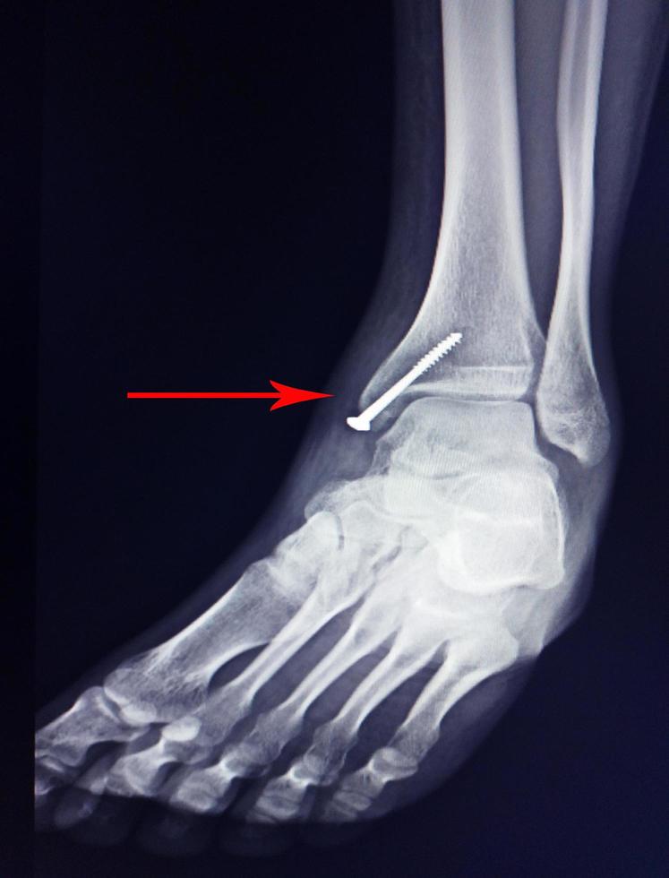 X-ray foot after operation fix screws in medial malleolus tibia. photo