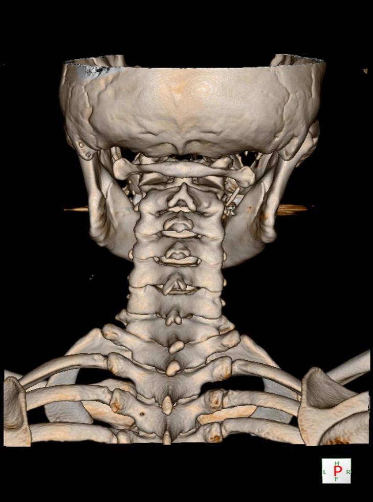 tomografía computarizada de la columna cervical 3 d render. foto