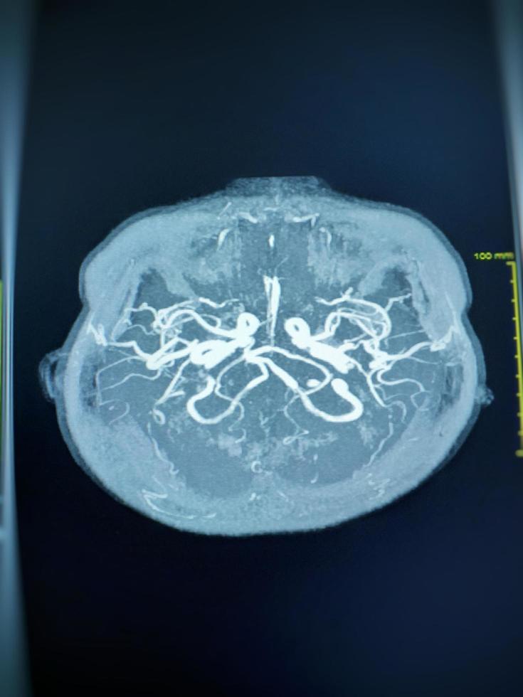 MRA AND MRV OF BRAIN History  female, presented with intracranial hemorrhage photo