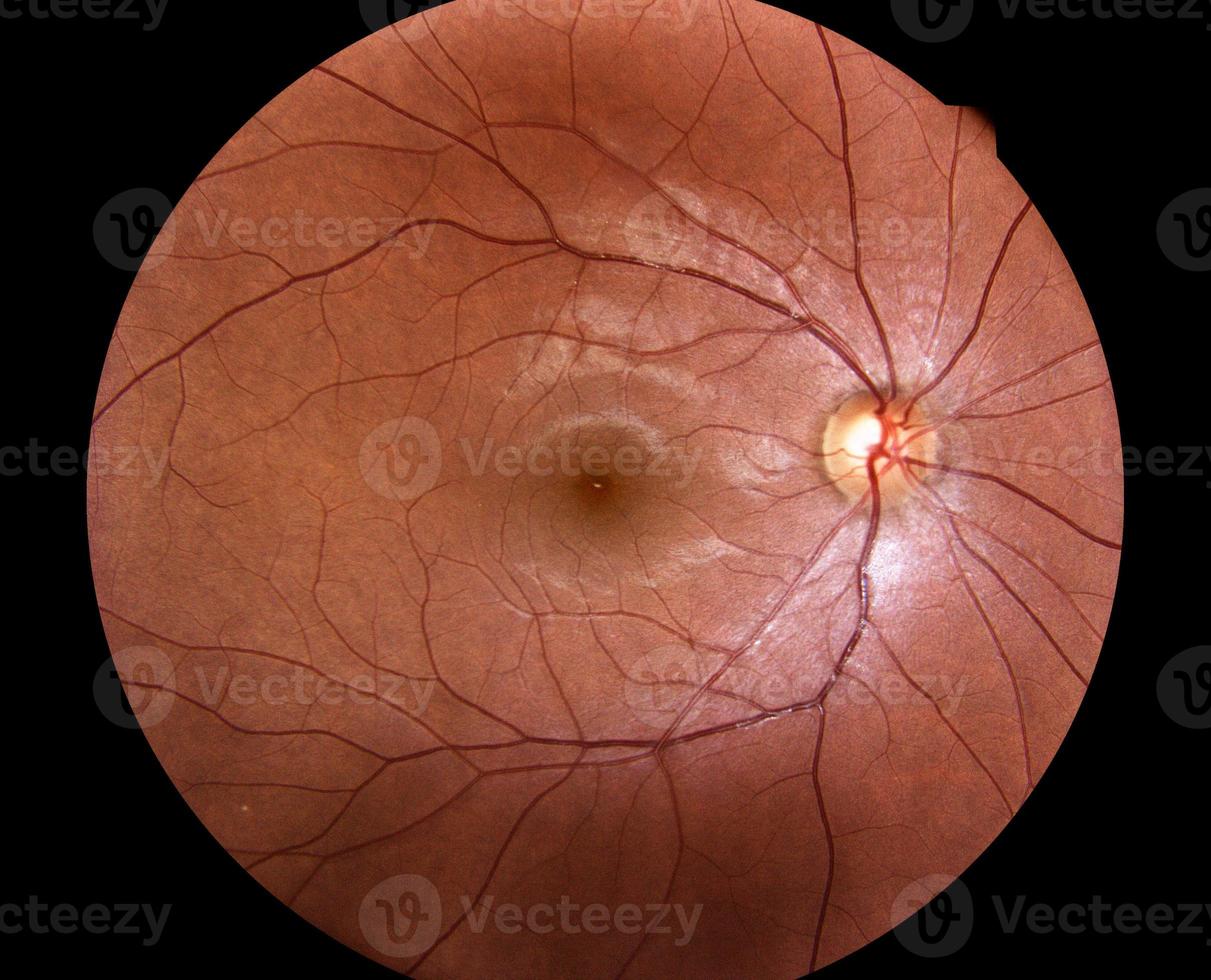 Medical photo retina of diabetic - exudate