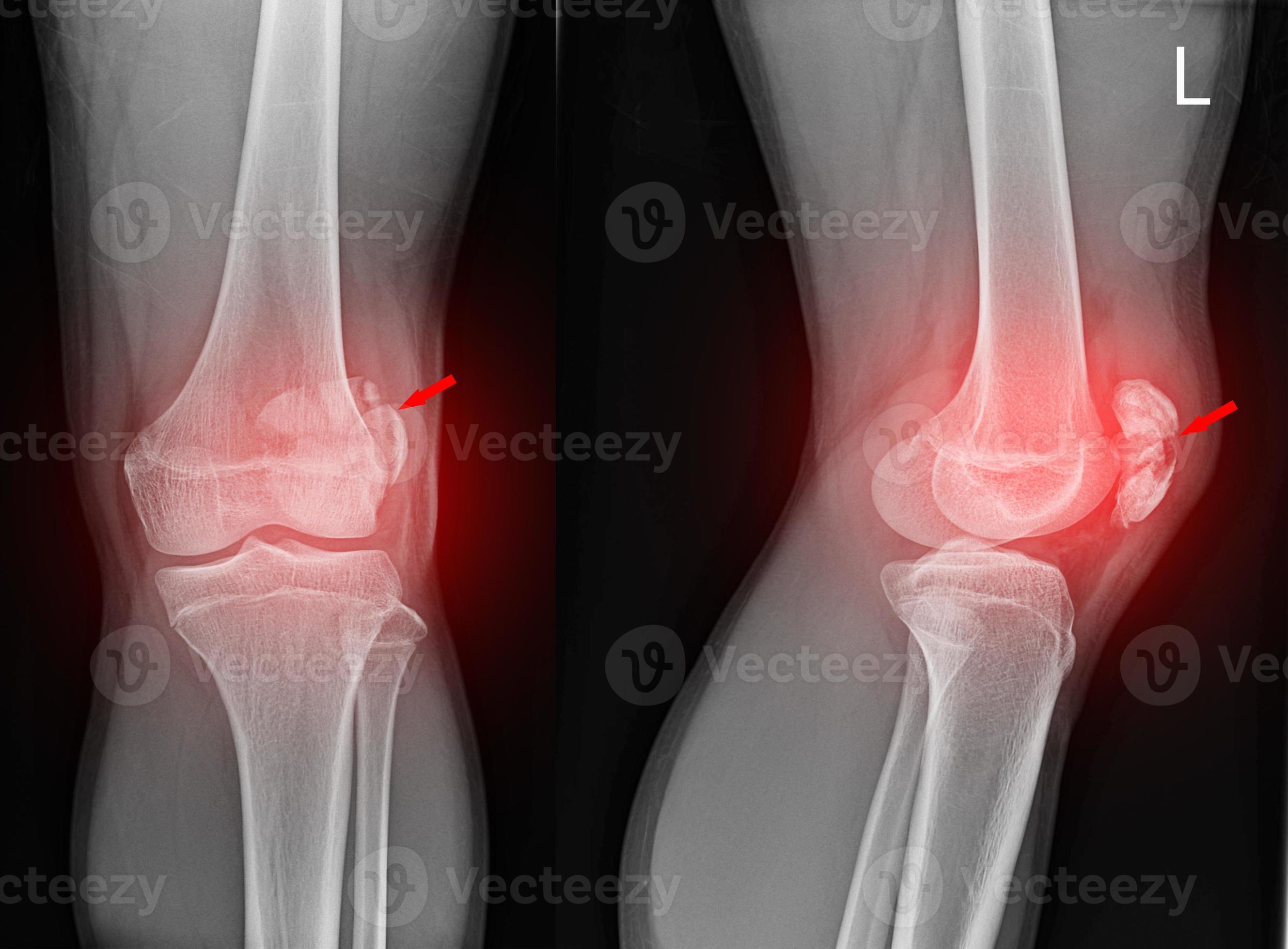 A film xray of left knee lateral view shown fracture of knee cap