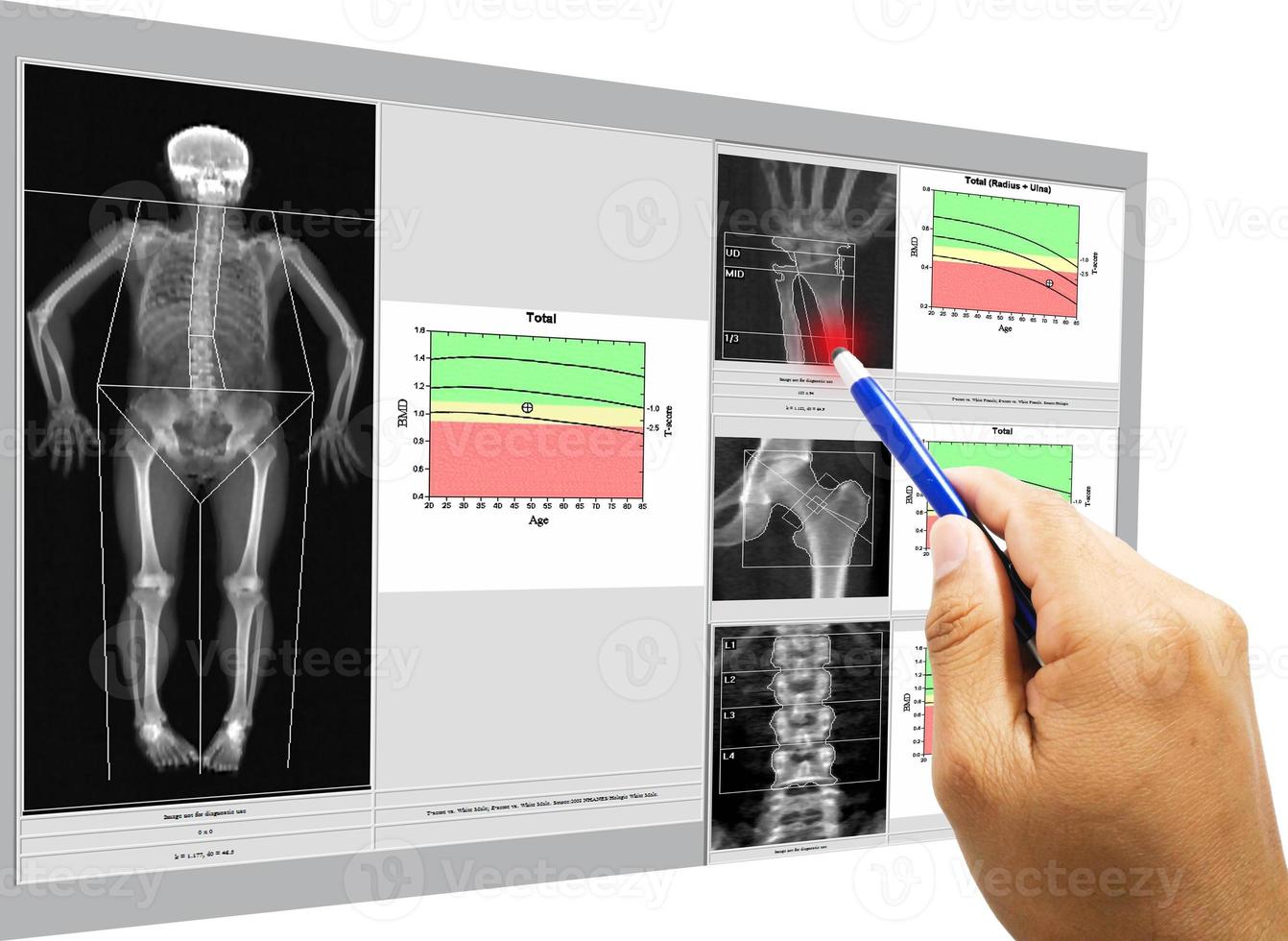 examen especial imagen médica densidad ósea una mujer de 65 años de edad, cuerpo entero y muñeca, cadera, columna vertebral, imagen demasiado borrosa cuando se ve la solución completa, concepto médico y tecnológico. foto