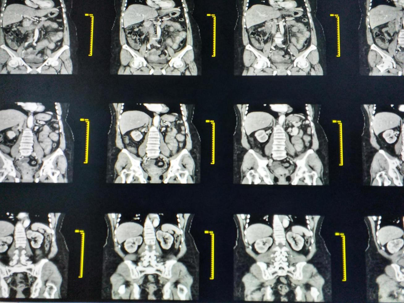 CT whole abdomen with contrast media coronal view . medical technology concept. photo