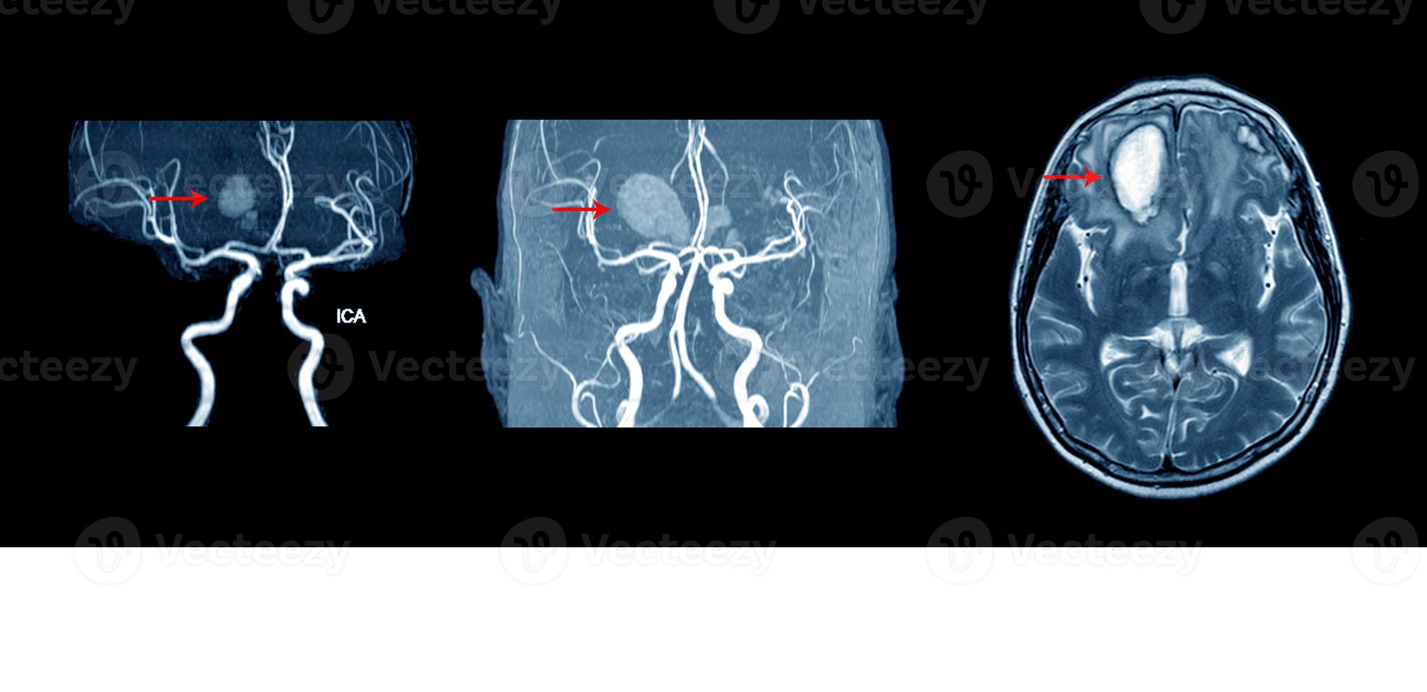 mri, mra y mrv de cerebro foto