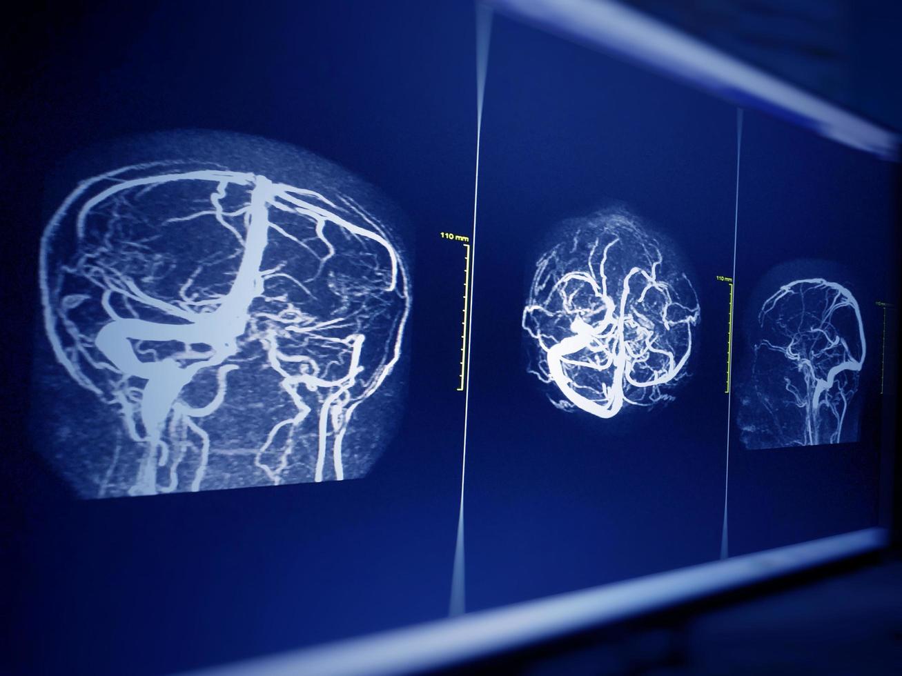 MRA AND MRV OF BRAIN Bilateral territorial muscles to the cortex and subcortical of the parietal and low hemispheres cerebellar. photo