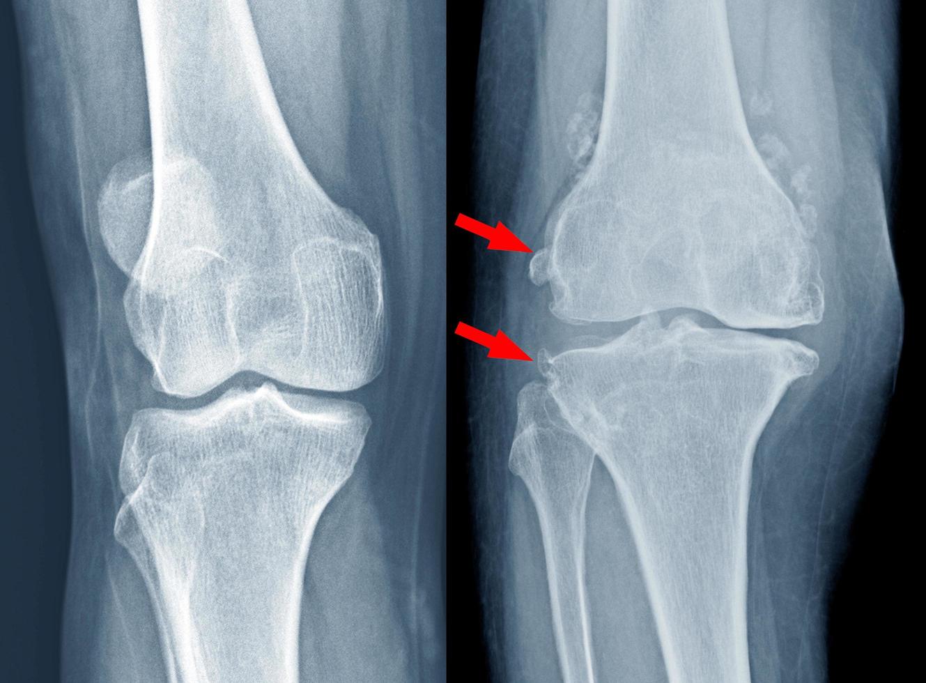 Osteoarthritis  knee . film x-ray photo