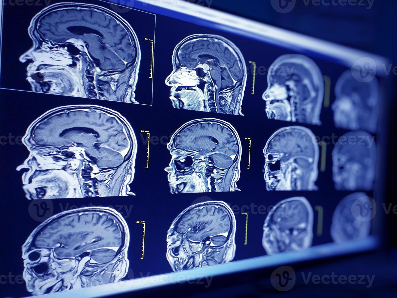 Magnetic resonance imaging brain of human brain with suspected cerebropathy photo