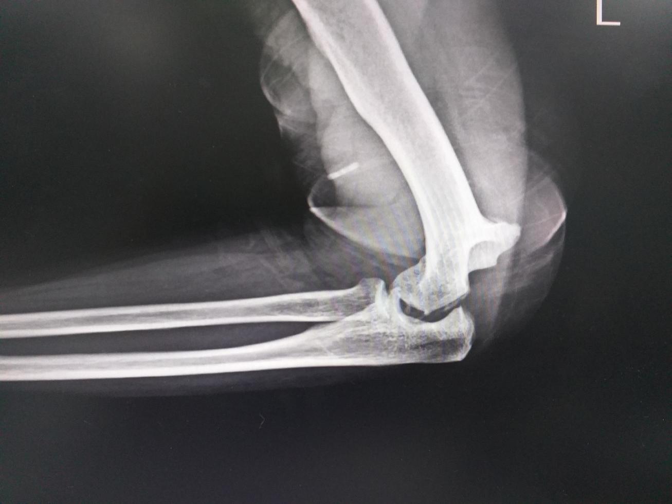 Elbow joint dislocation  x-ray image. photo