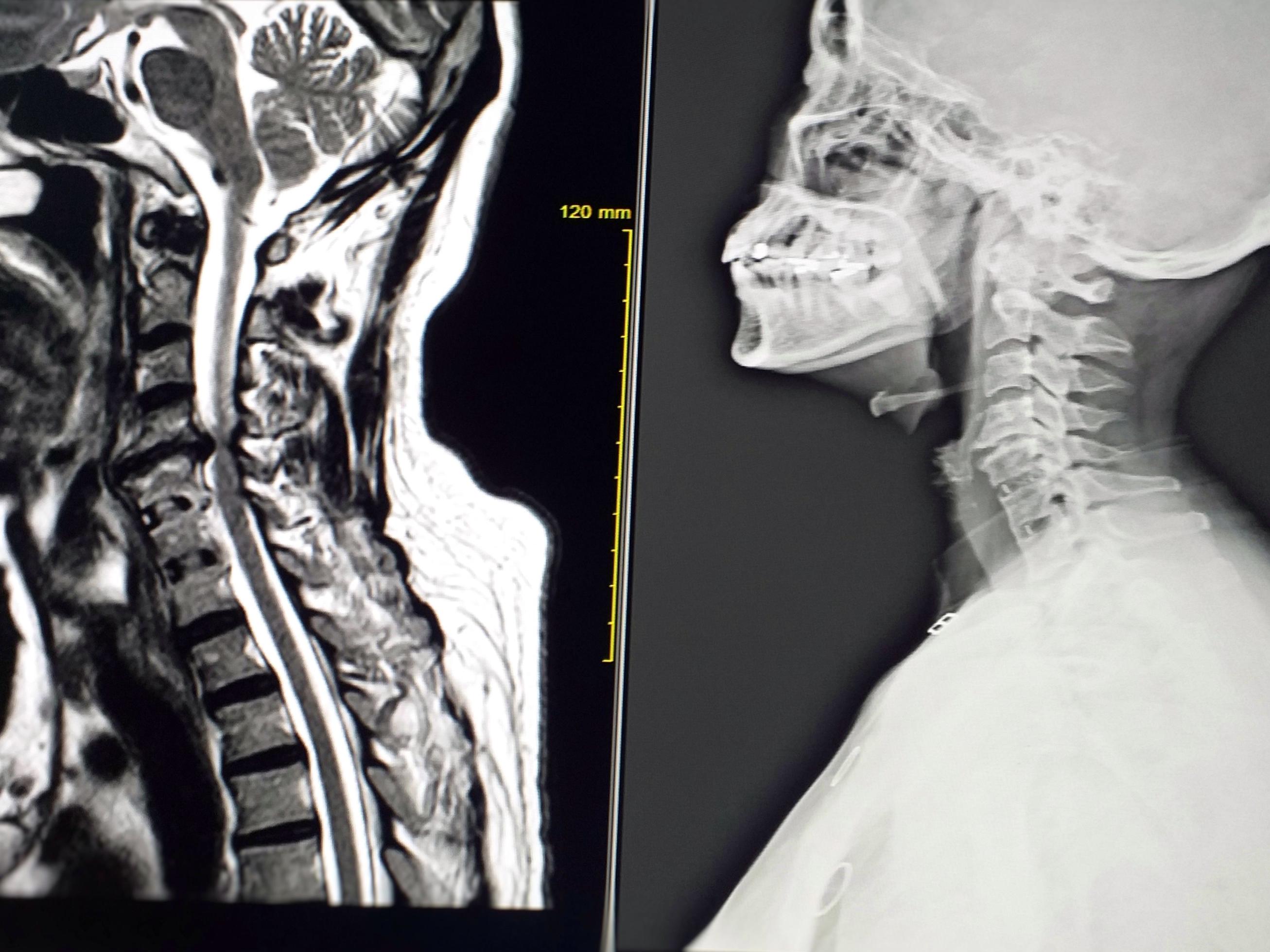 Obniżone Napięcie Mięśniowe U Dwulatka MRI Cervical-spine Shows C4-C5 Moderate spinal cord compression